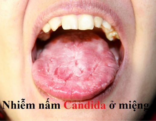 Nhiễm nấm Candida ở miệng – nguyên nhân – triệu chứng – cách điều trị